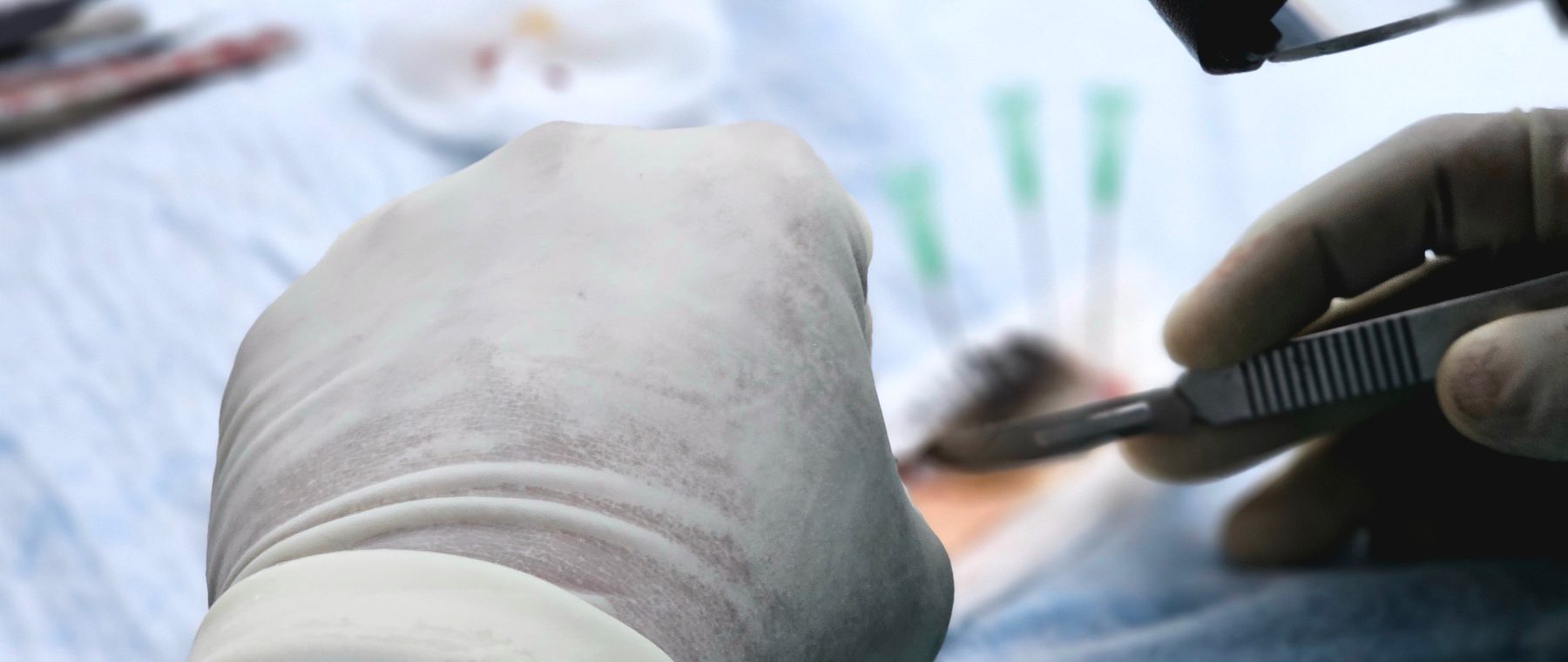 Greffe de cheveux et sexe : quel est vraiment le lien ?