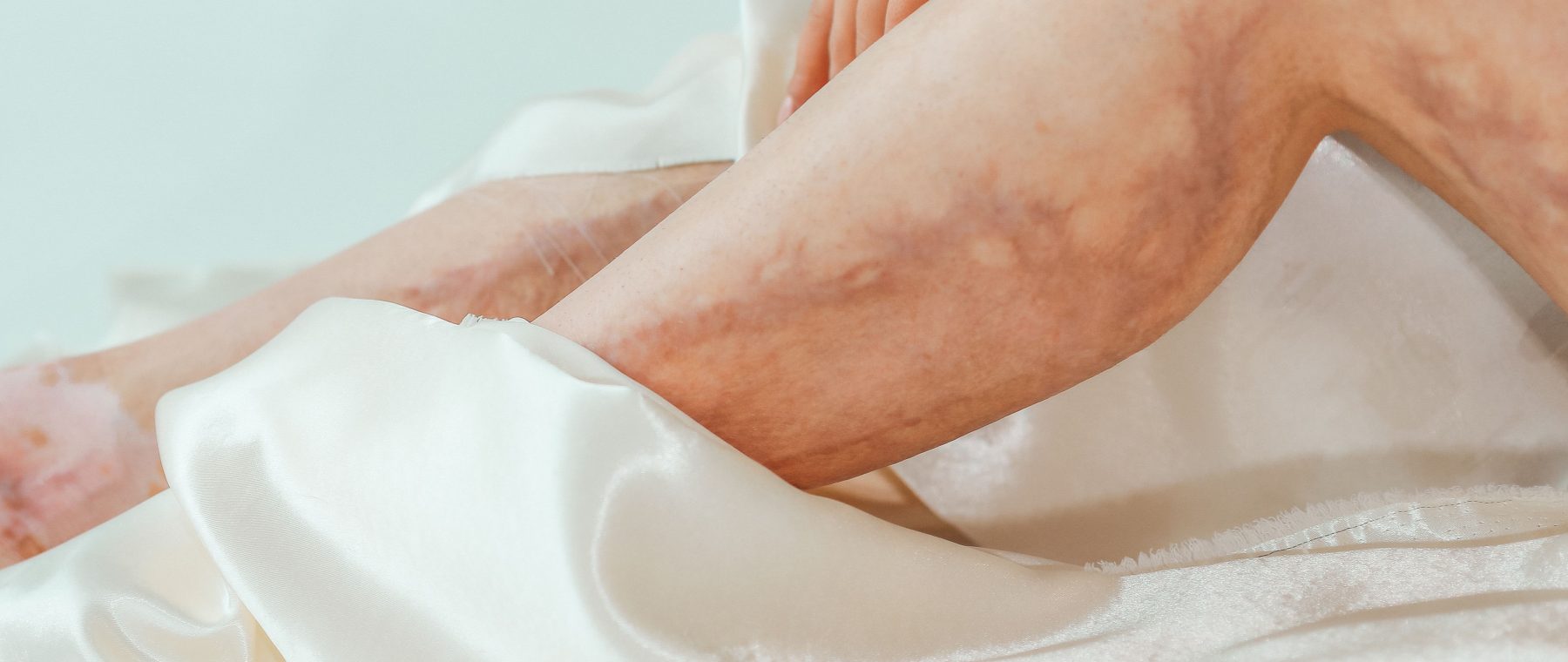 Laser vasculaire avant après : quels résultats attendre vraiment ?